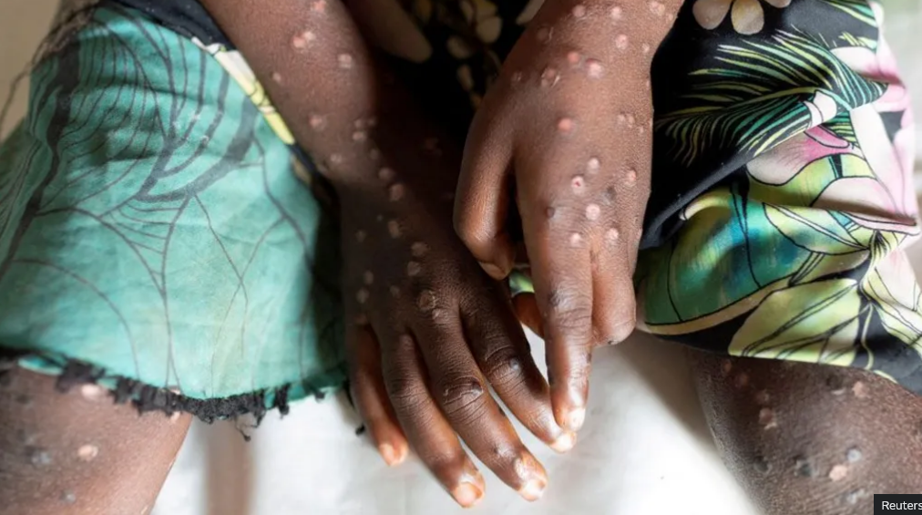 Mpox declared public health emergency in Africa